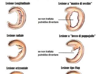 Tipologie di lesioni meniscali