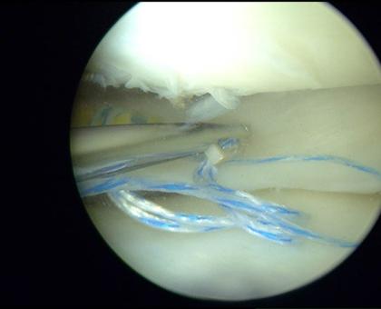 Sutura meniscale